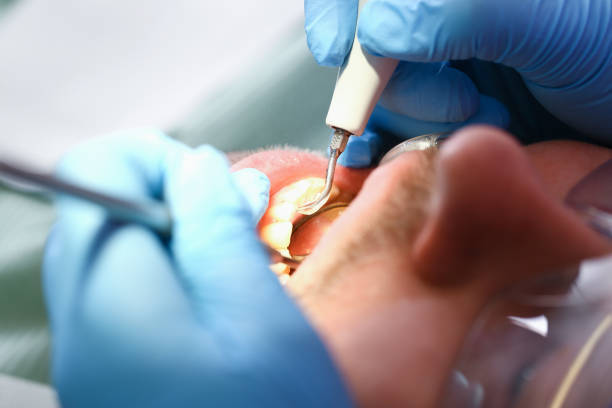 Best Emergency Dental Extractions in Tusculum, TN